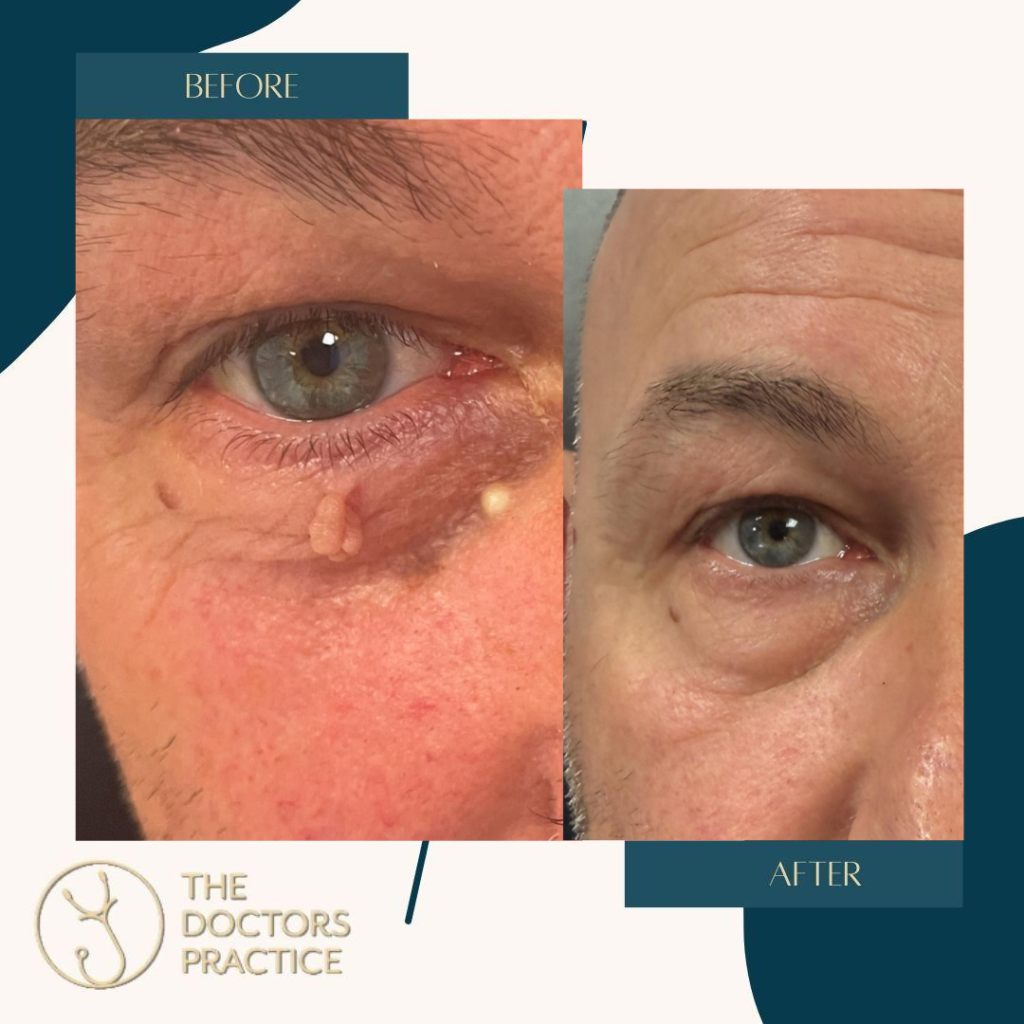 Treatment of Skin Lesions