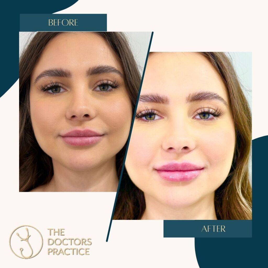 Lip Filler