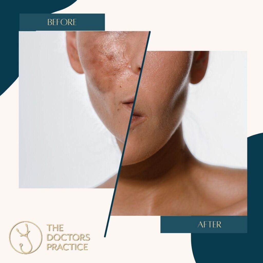 Advanced Hyperpigmentation