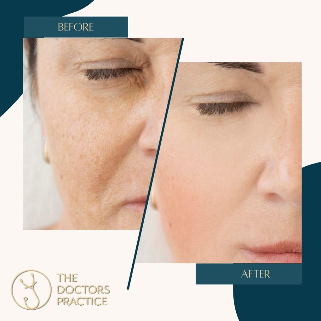 Skin Booster Skin Booster