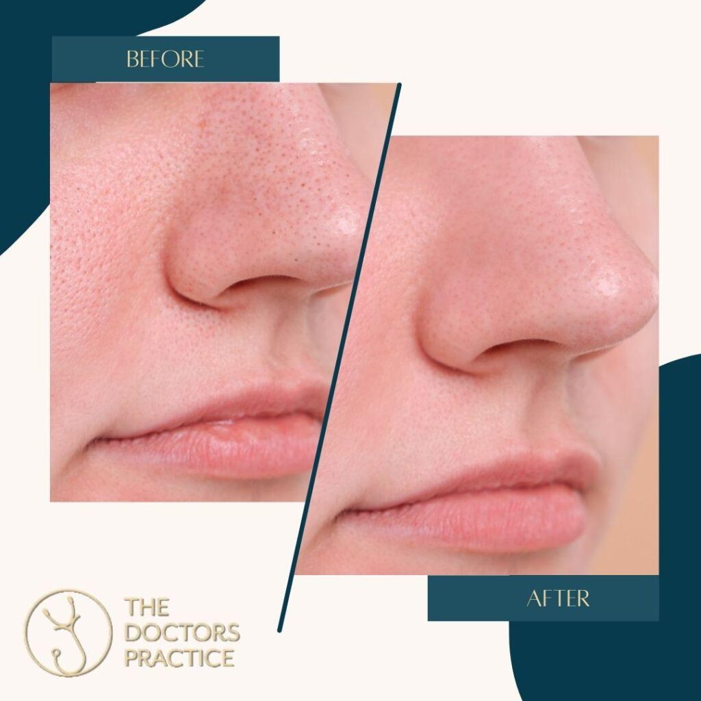 Skin Booster Skin Booster