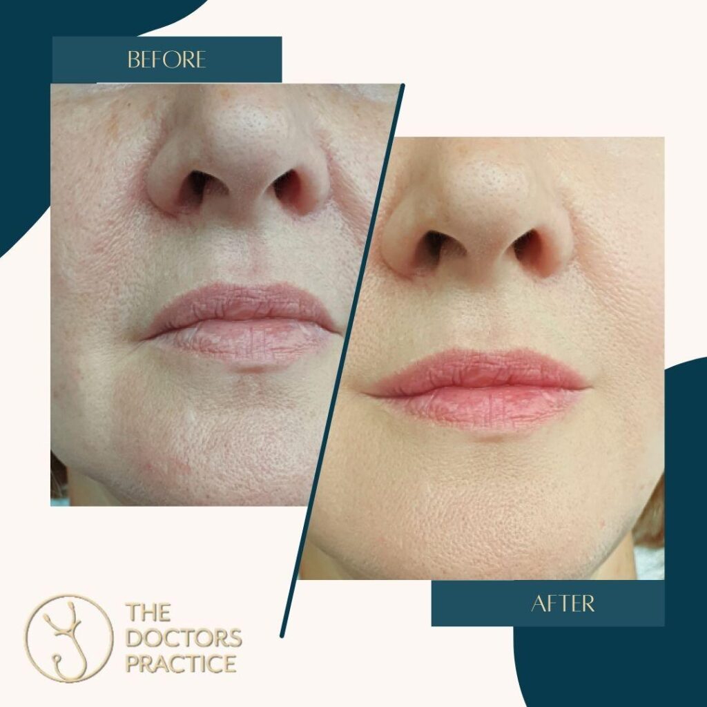 Perioral lines Perioral lines