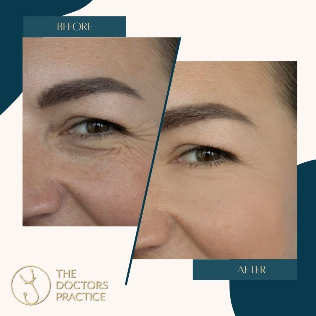 Microneedling Microneedling