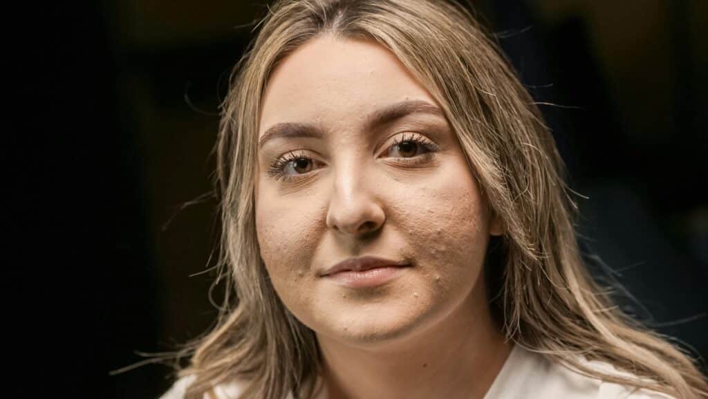 Hormonal Acne in Women: Medical Causes No One Talks About | The Doctor’s Practice Birmingham Hormonal Acne in Women: Medical Causes No One Talks About | The Doctor’s Practice Birmingham