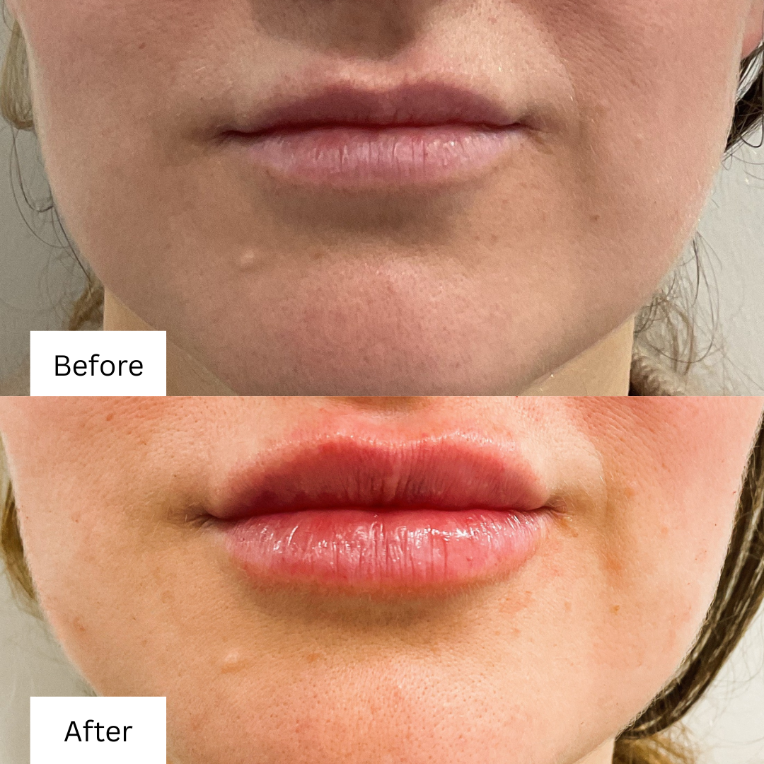 Before and after Lip Filler 2