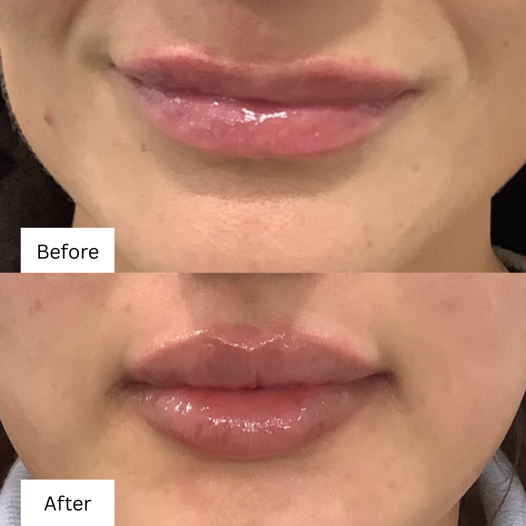 Before and after Lip Filler