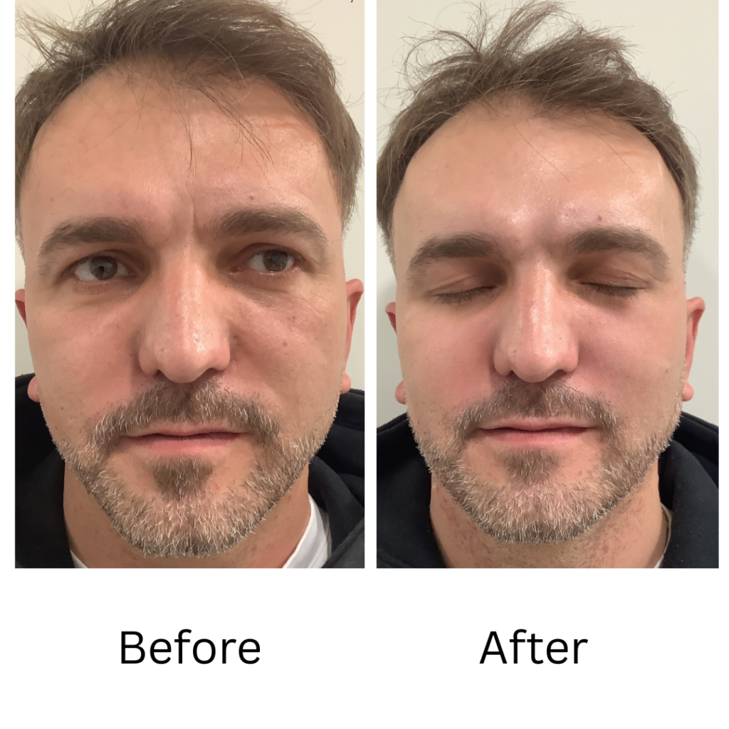Chin & Jaw Line Fillers