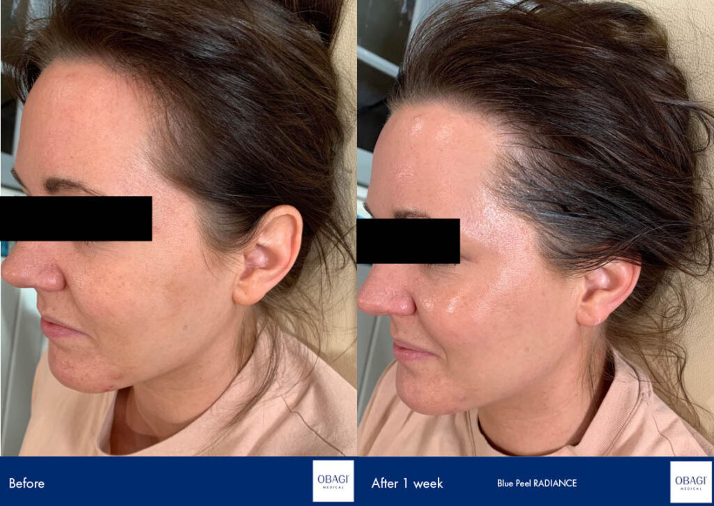 chemical peel before and after