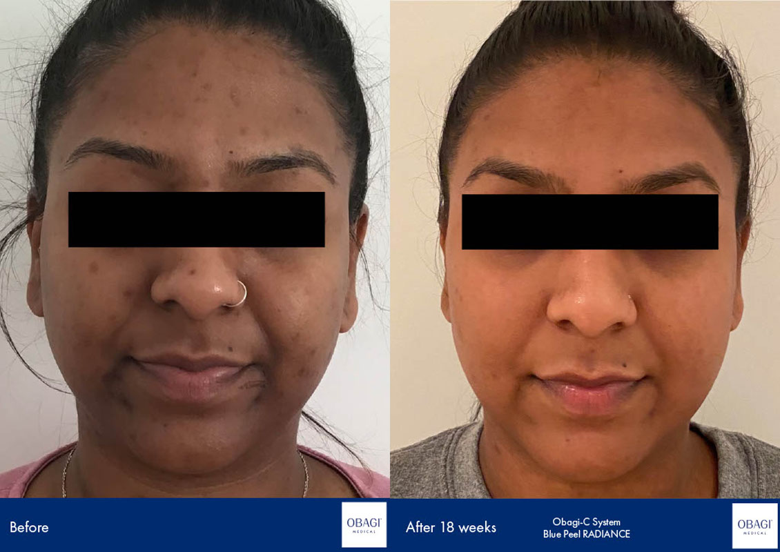 Before and after skin treatment results