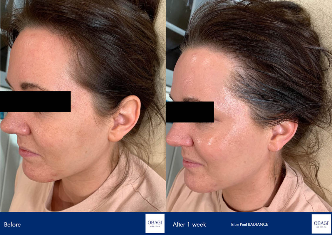 chemical peel before and after