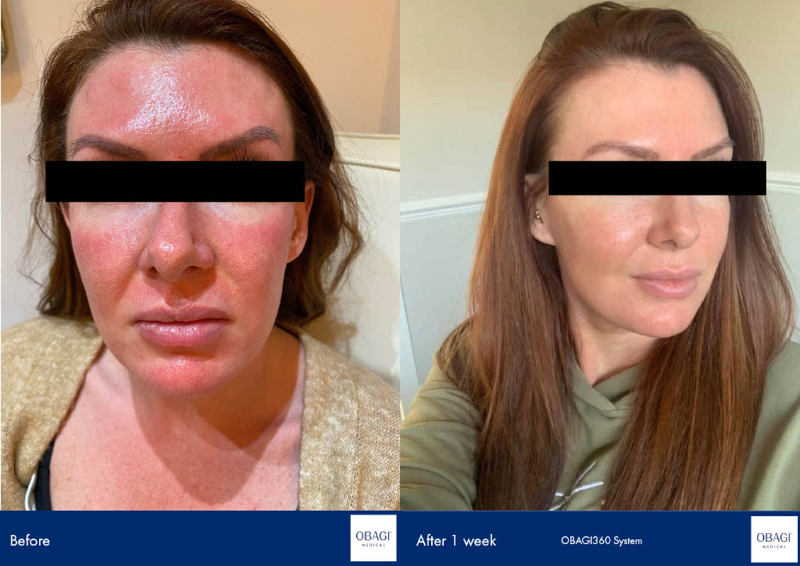 chemical peel in birmingham