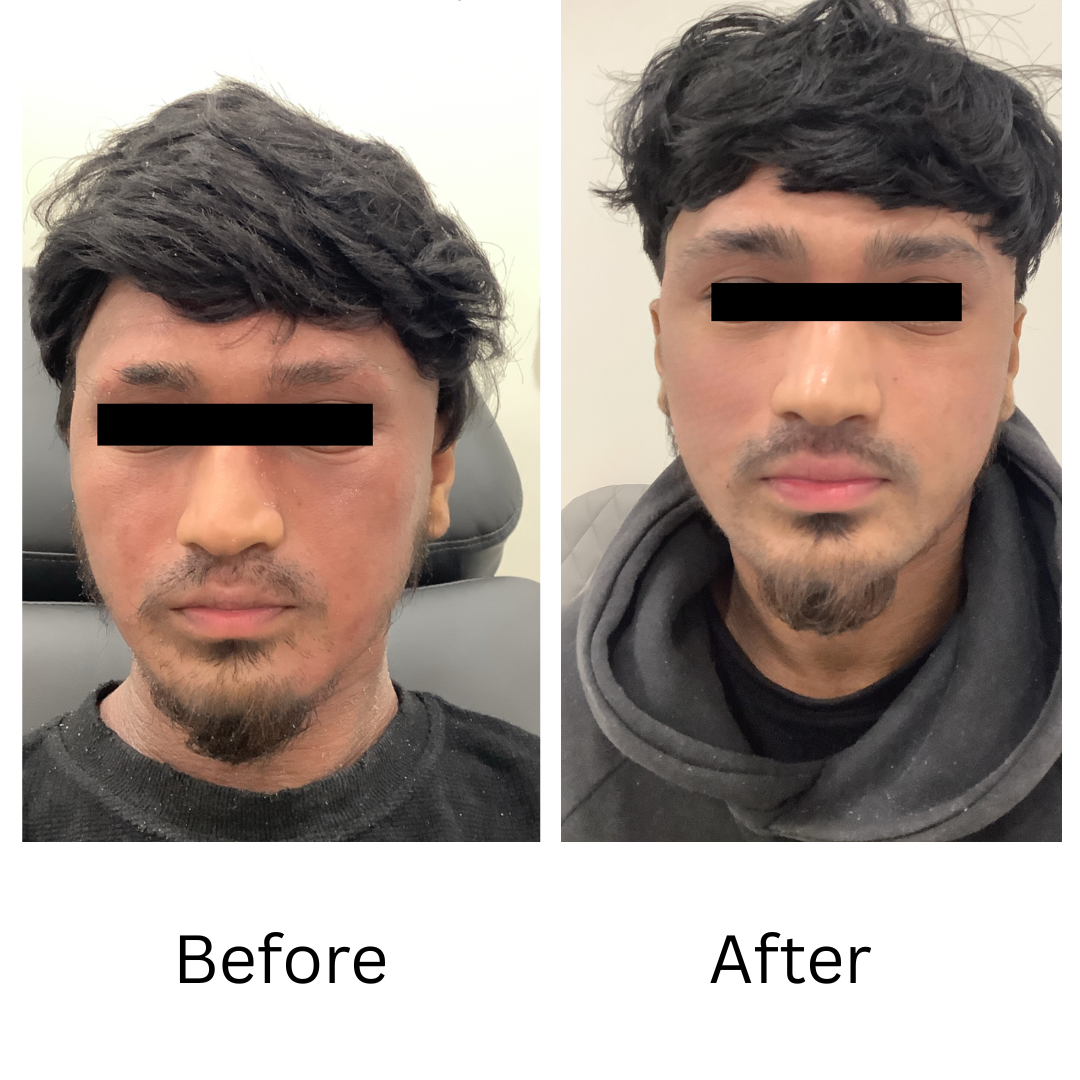 Topical Steroid Withdrawal Before and after topical steroid withdrawal Treatment