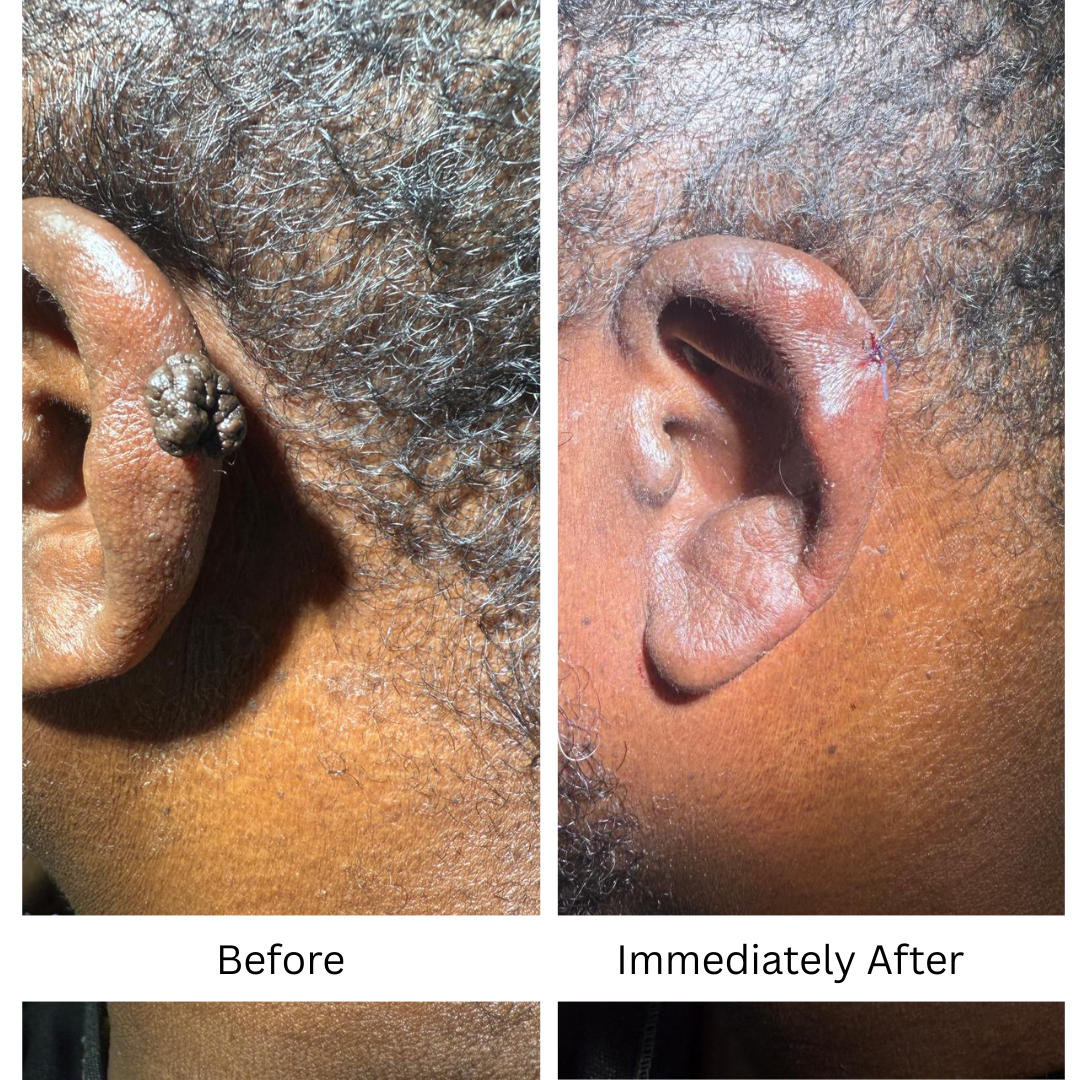 Before Mole Removal