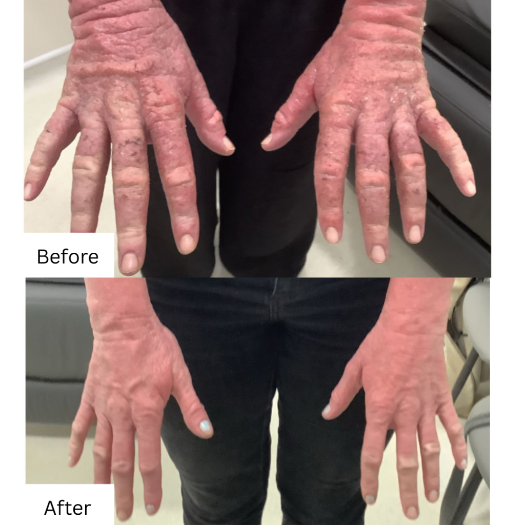 CAP THERAPY FOR TSW ON HANDS