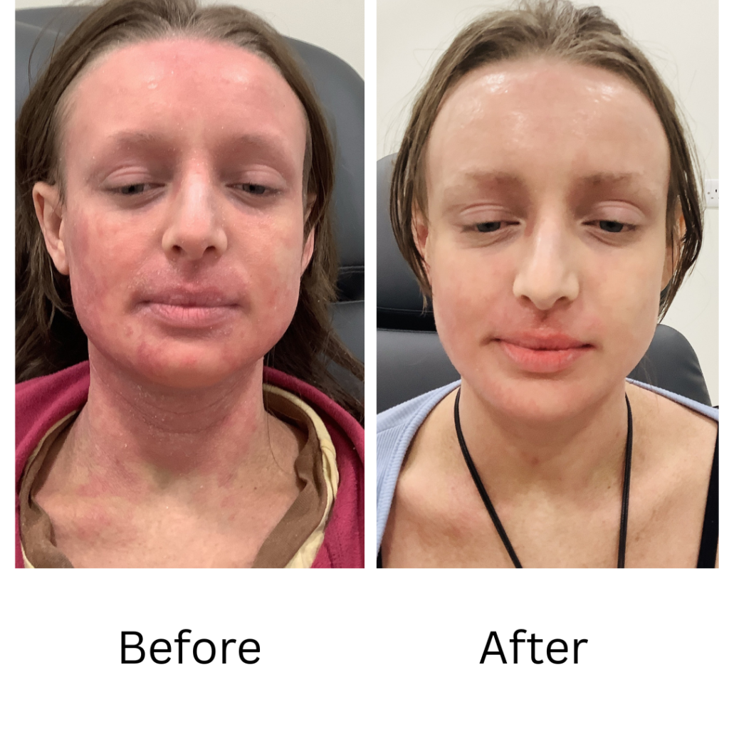 Cold Atmospheric Plasma (CAP) Treatment Birmingham