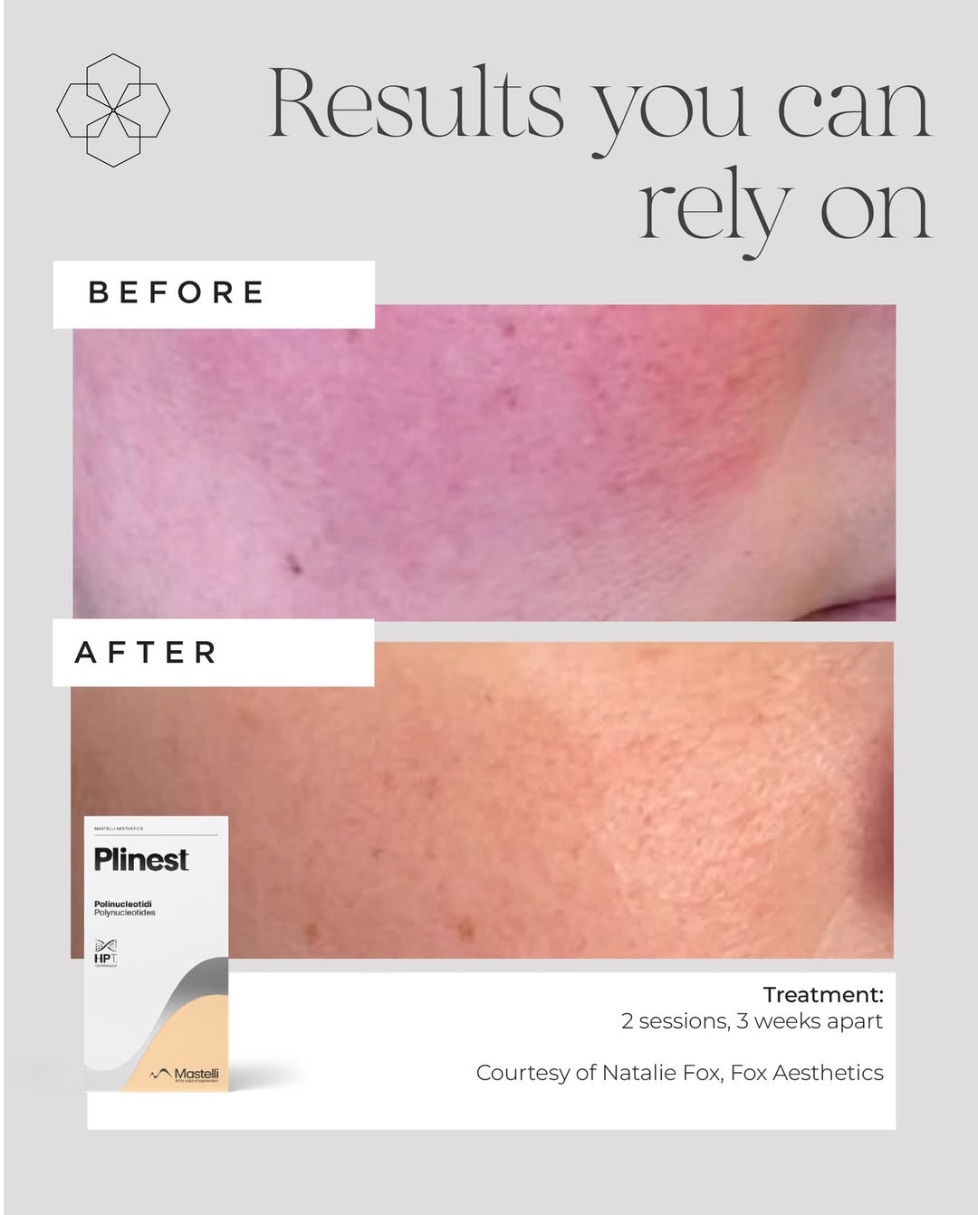 Rosacea polynucleotides before and after