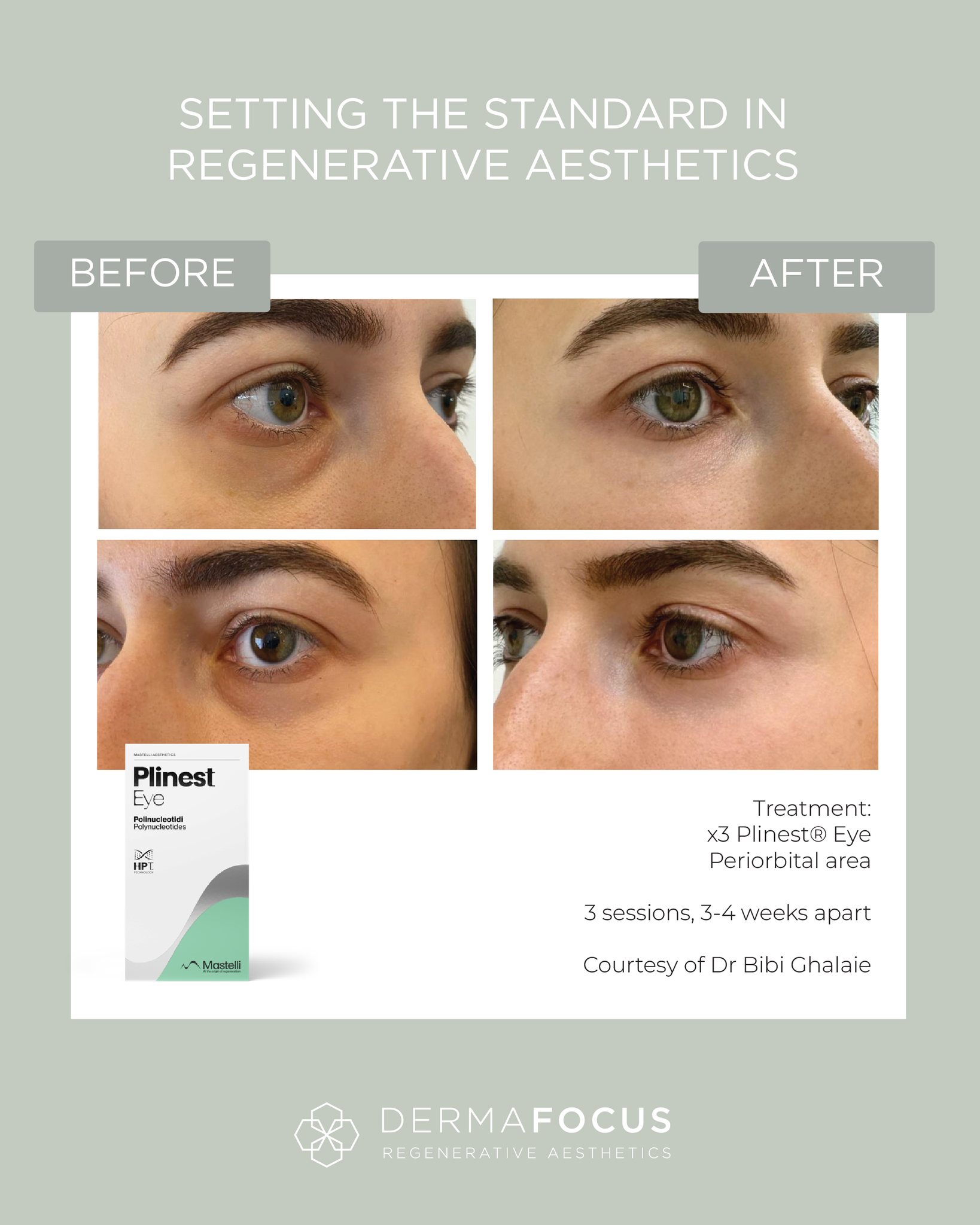 before and after eye rejuvenation