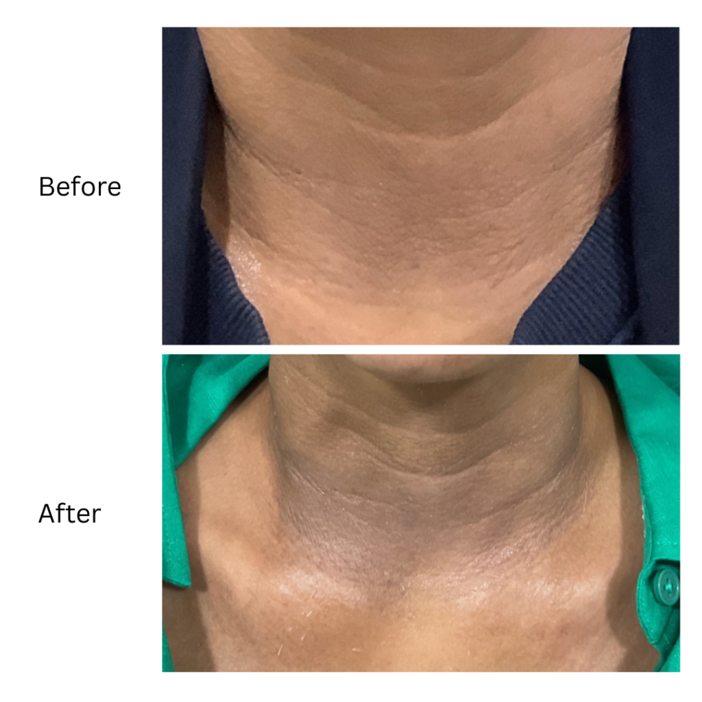 before and after hyperpigmentation