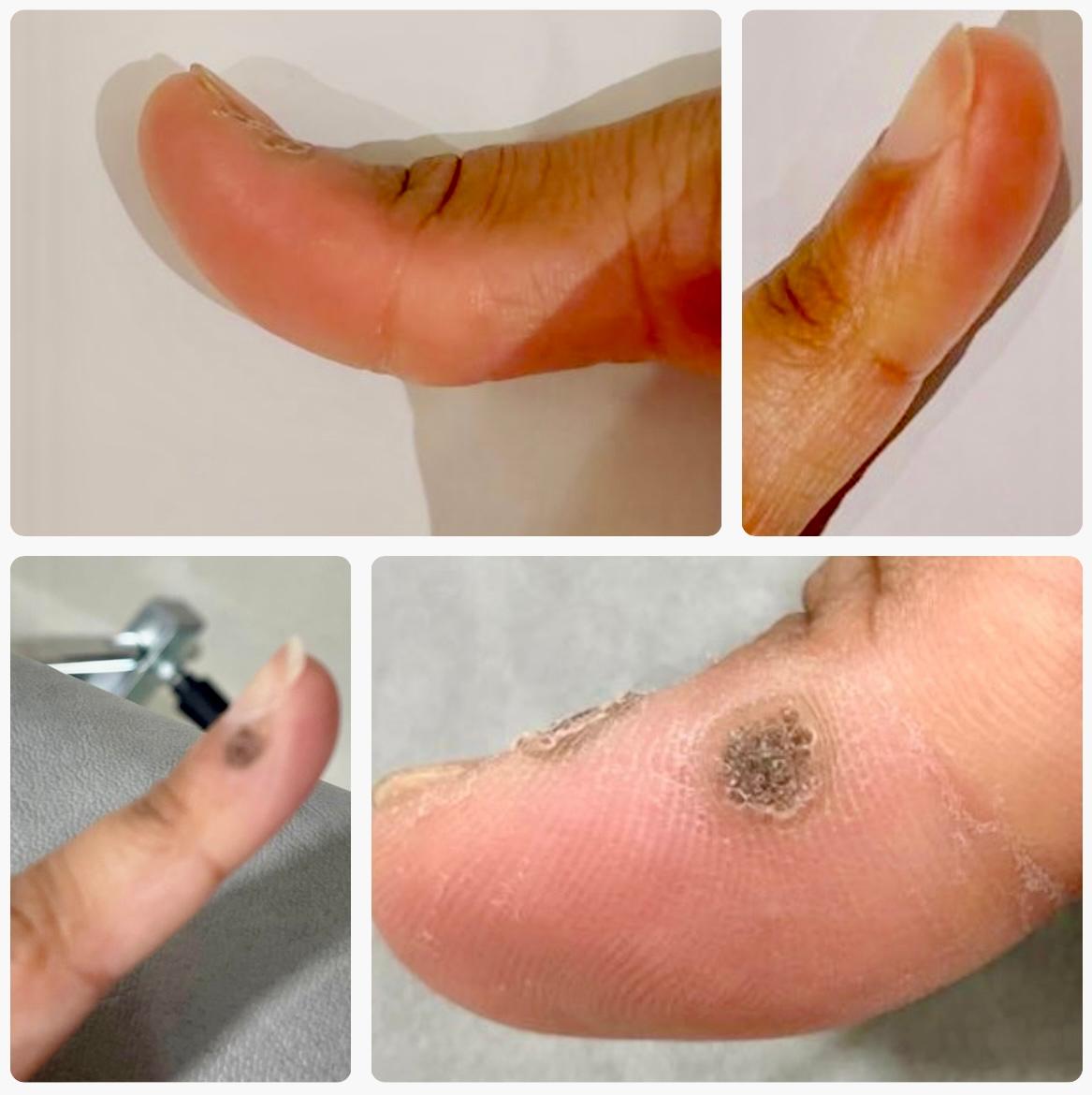 wart removal birmingham
