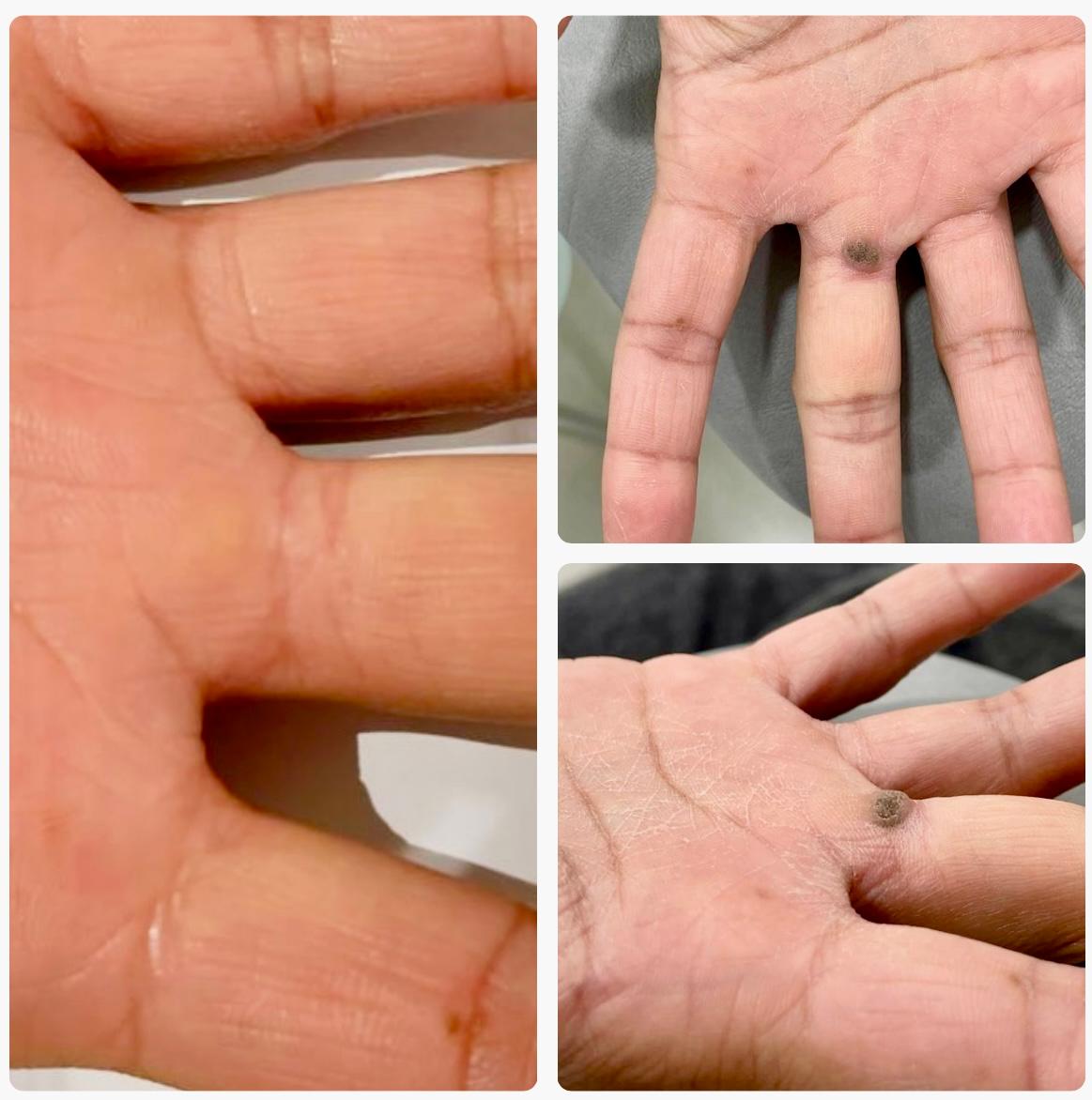 wart removal