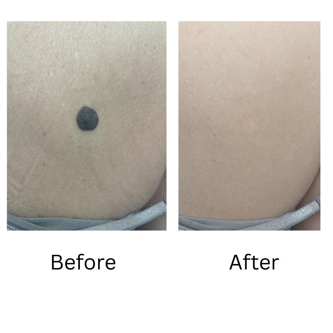 Before Mole Removal (2)