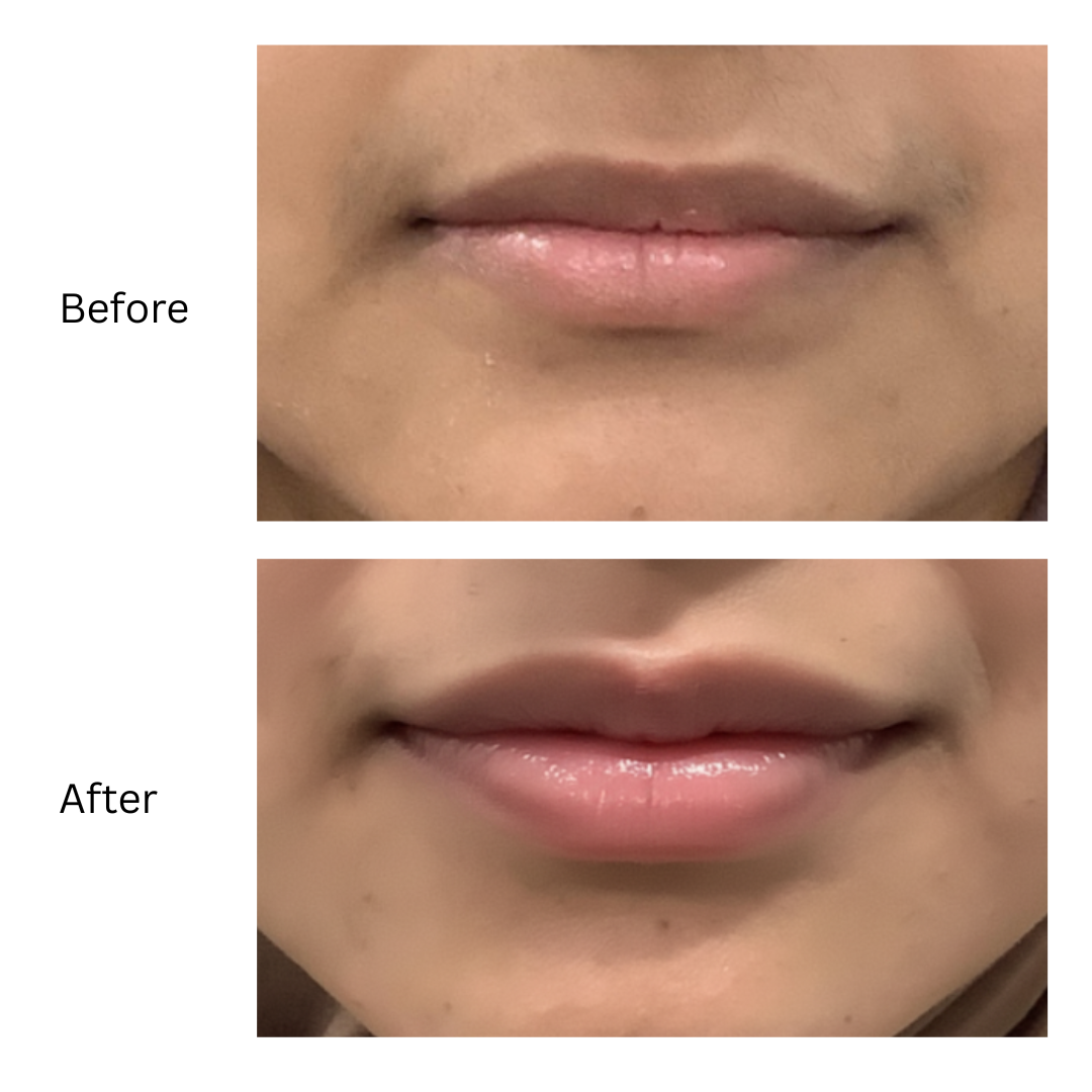 Before lip filler