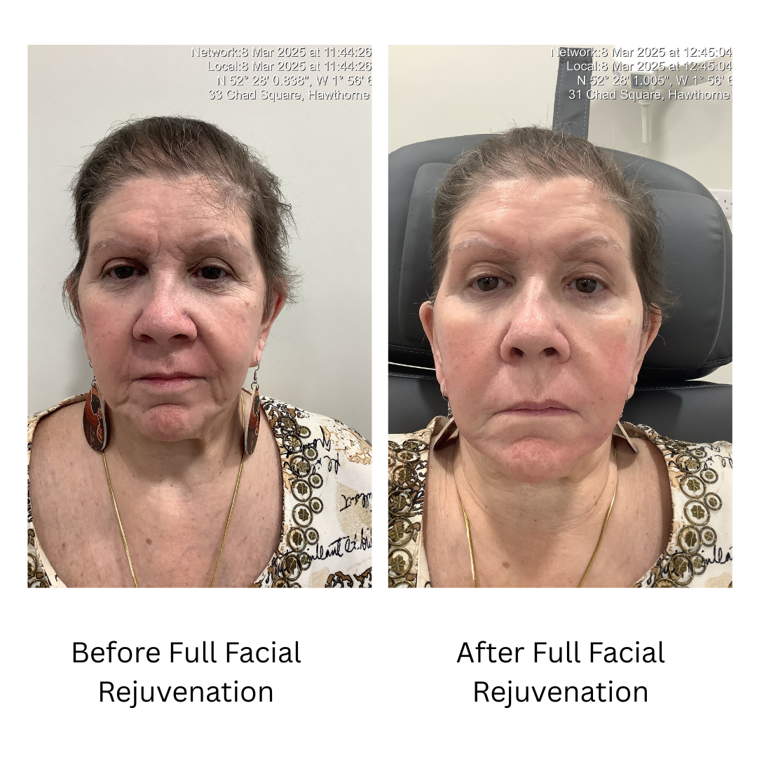 before and after facial rejuvenation