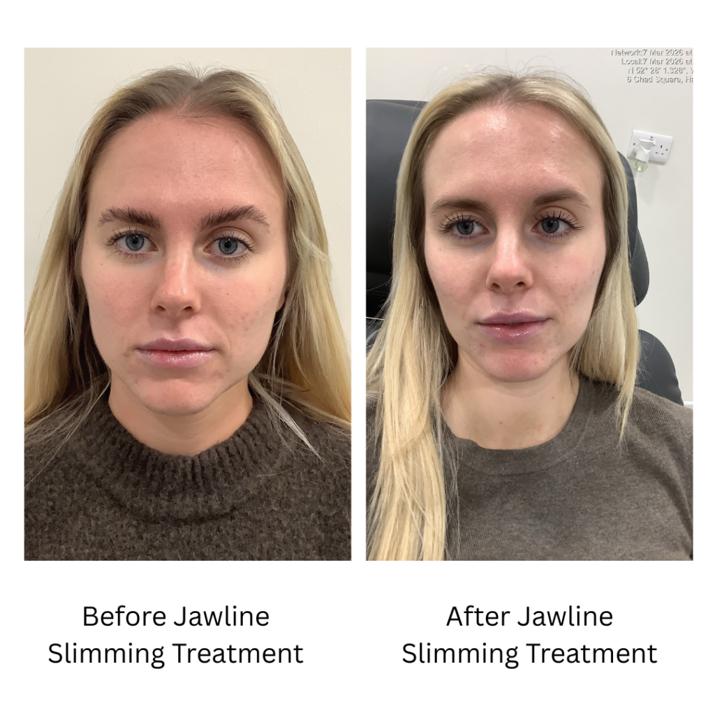 Masseter Botox