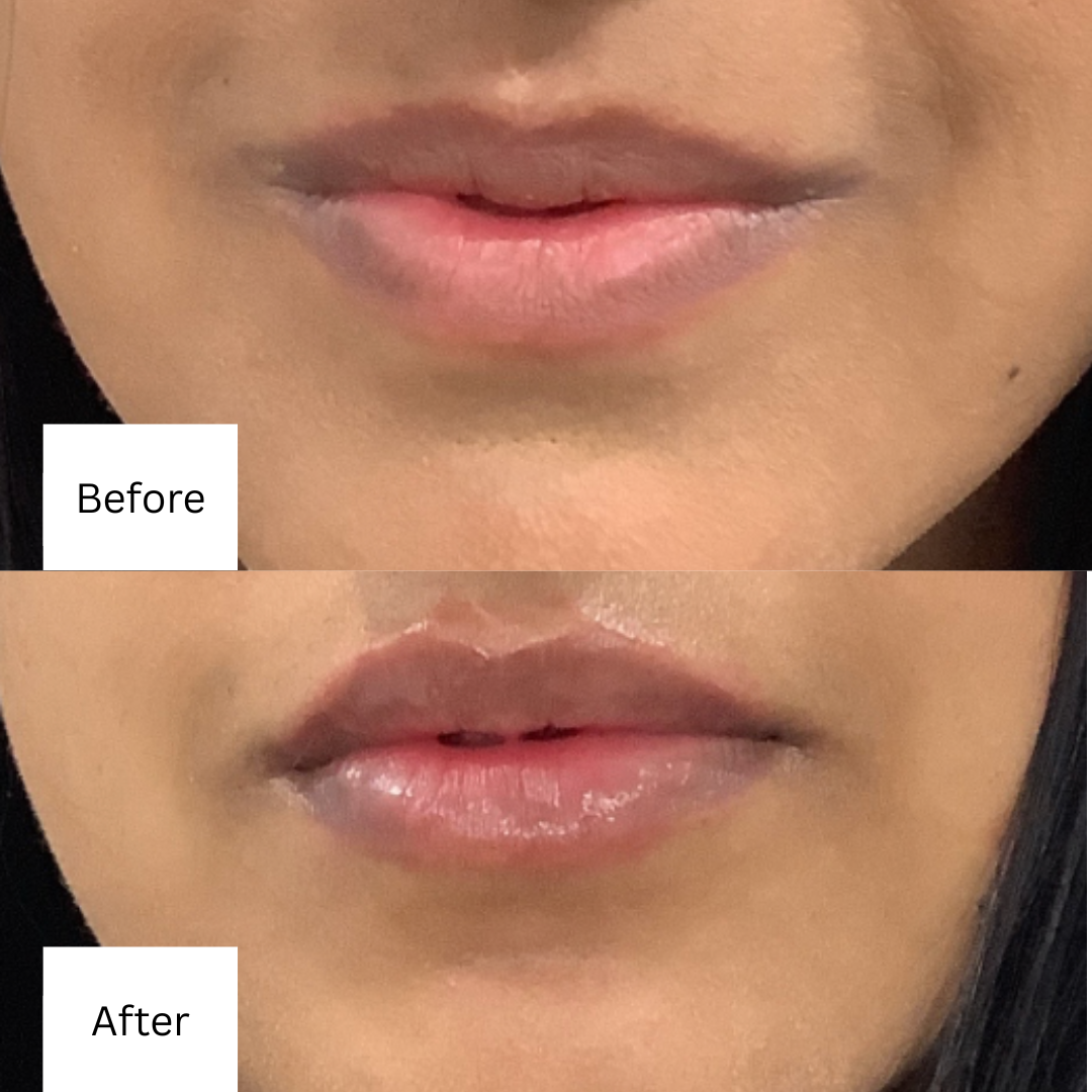 before and after lip fillers 1