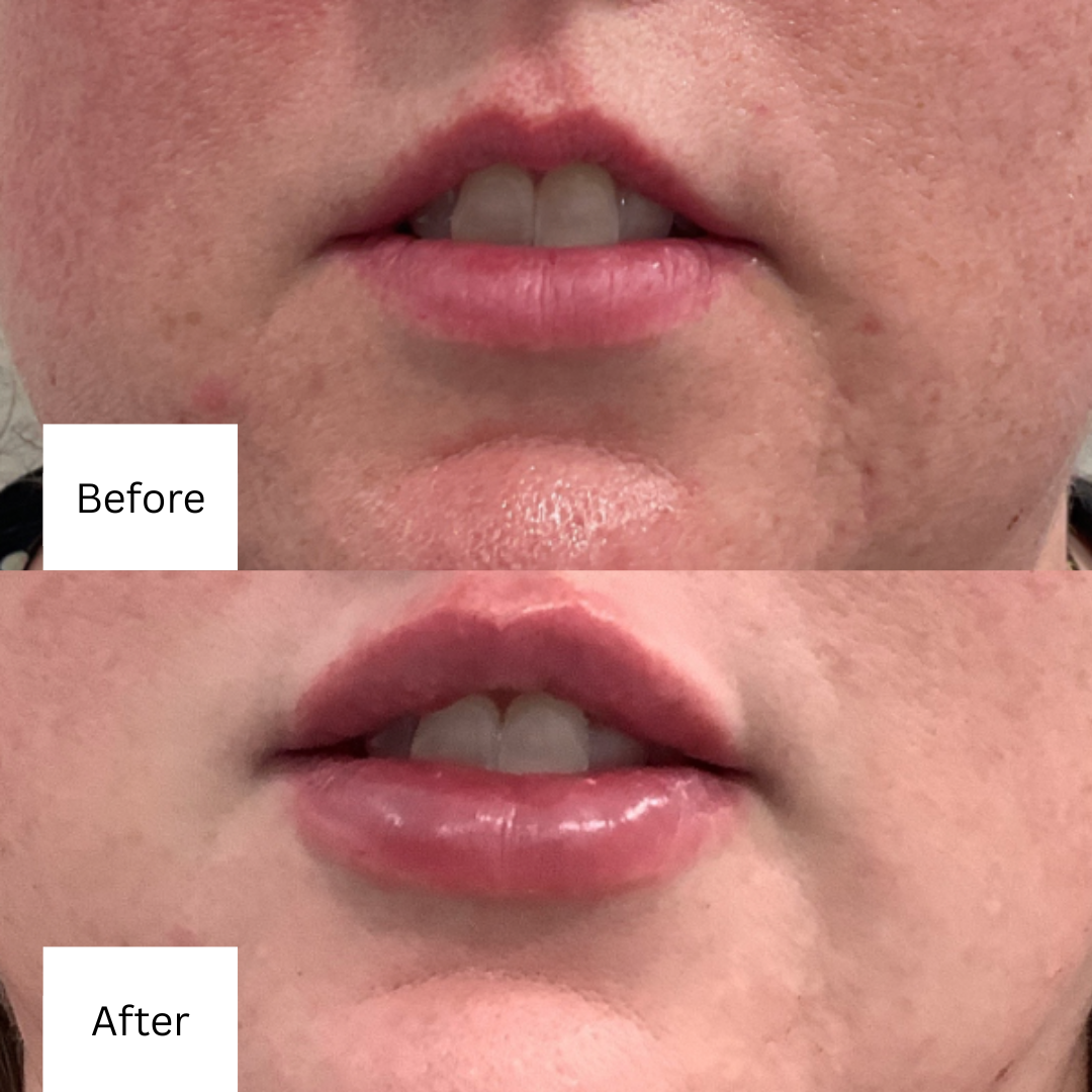 before and after lip fillers 2
