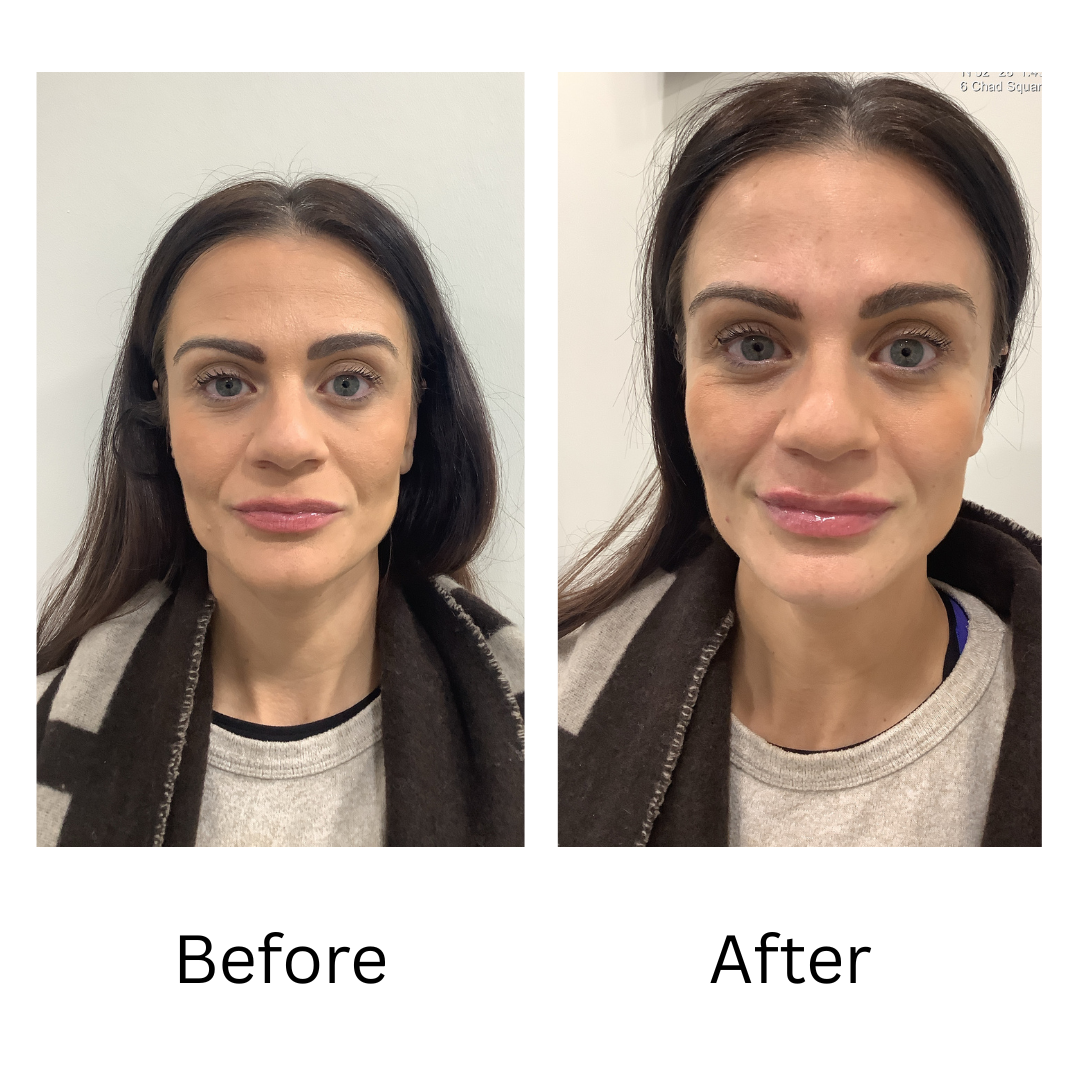 before and after lip fillers