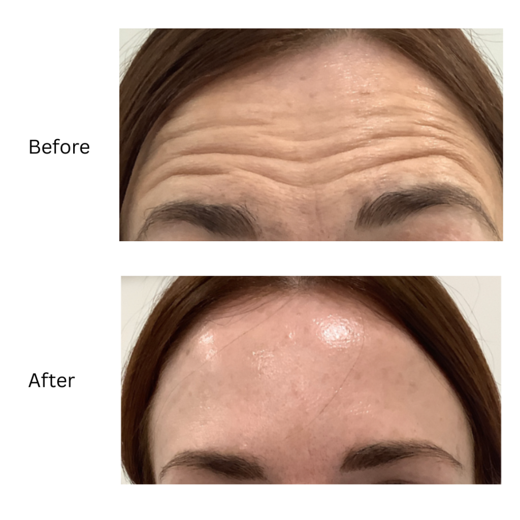 botox treatment birmingham