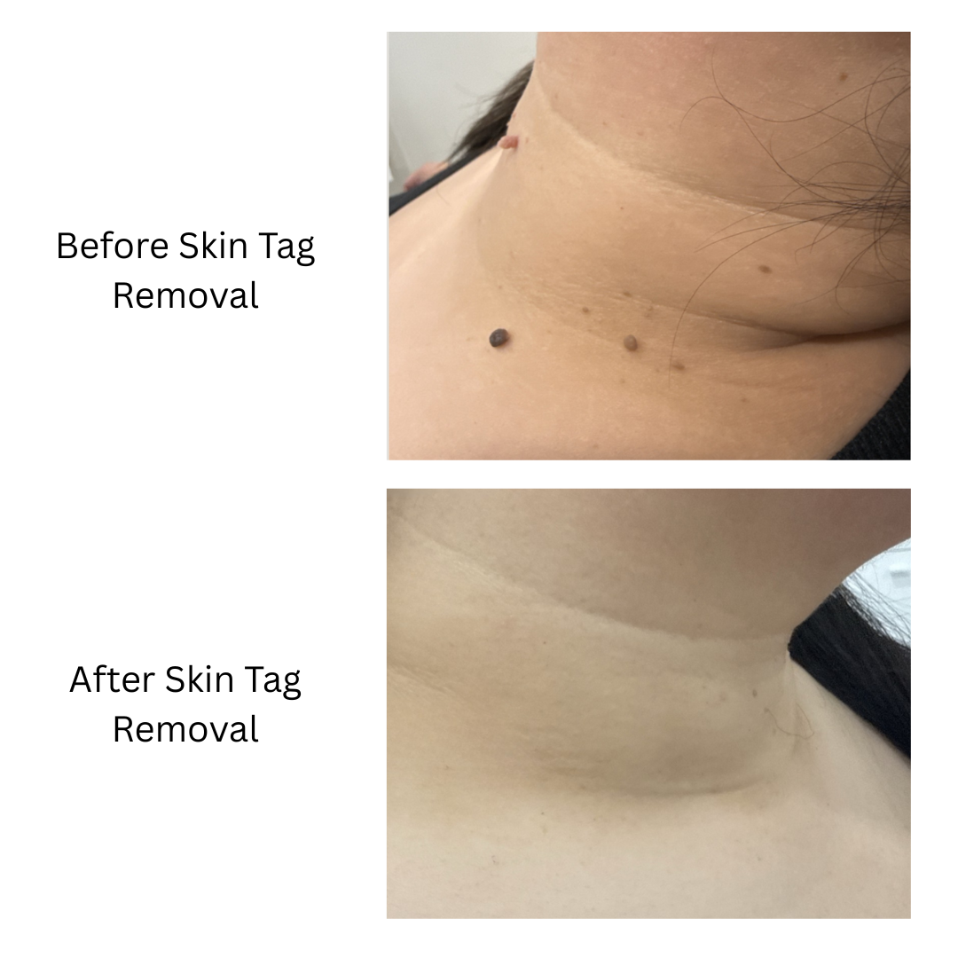 skin tag removal