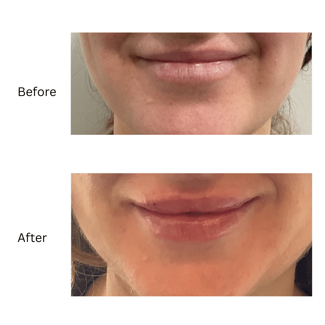 Before and after lip filler