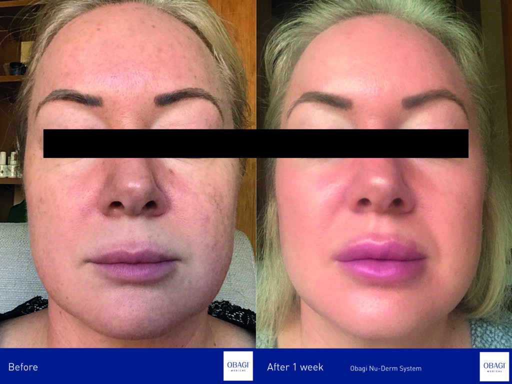 before and after rosacea
